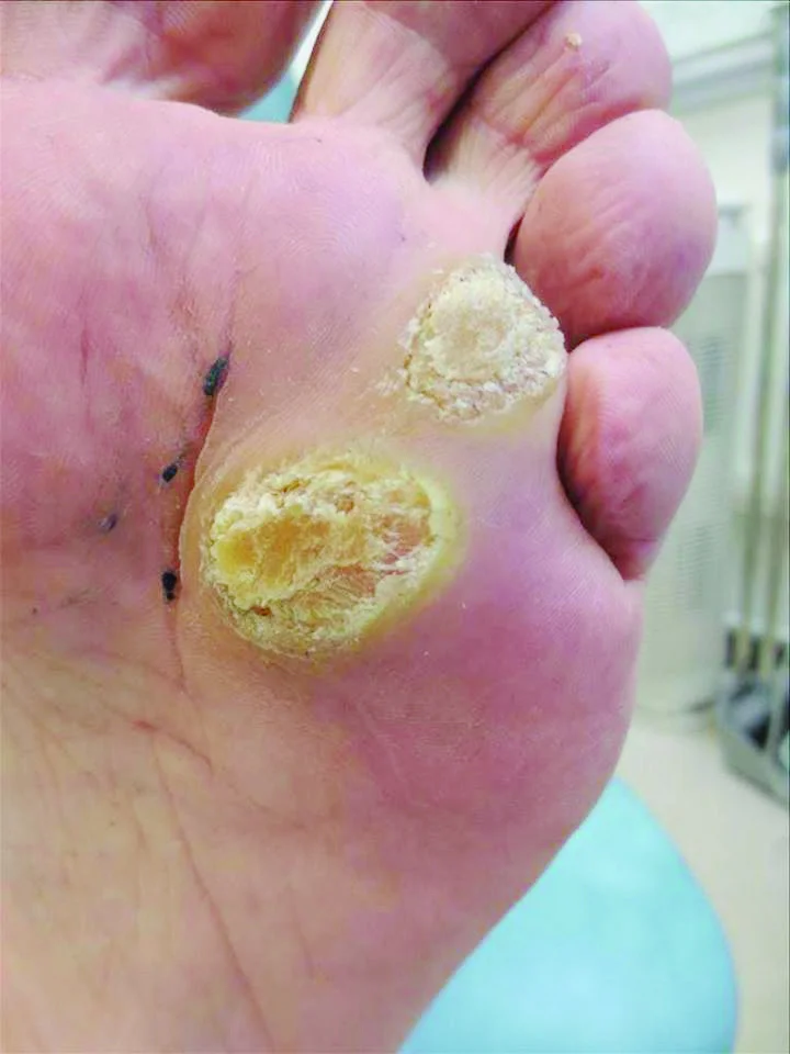 Swift 2 Large Forefoot Lesions