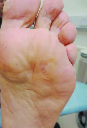 Swift 2 Large Forefoot Lesions Resolved